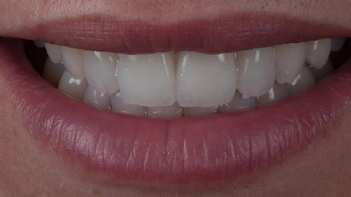 Текстура поверхности: использование горизонтальных и вертикальных линий для имитации естественного внешнего вида зубов