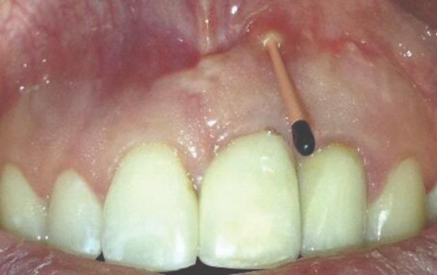 Лечение ретроградного периимплантита с использованием направленной костной регенерации