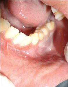 Множественные кисты челюстей: синдром Горлин-Гольца