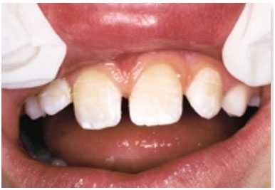 Лечение скола зуба ребенка