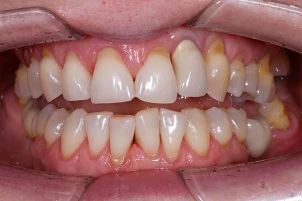 Аутотрансплантация зуба 28-26