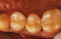 Как правильно установить матрицу при лечении зубов