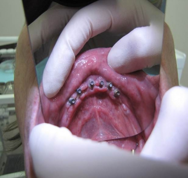 Удаление зубов с одномоментной установкой имплантов Nobel Biocare