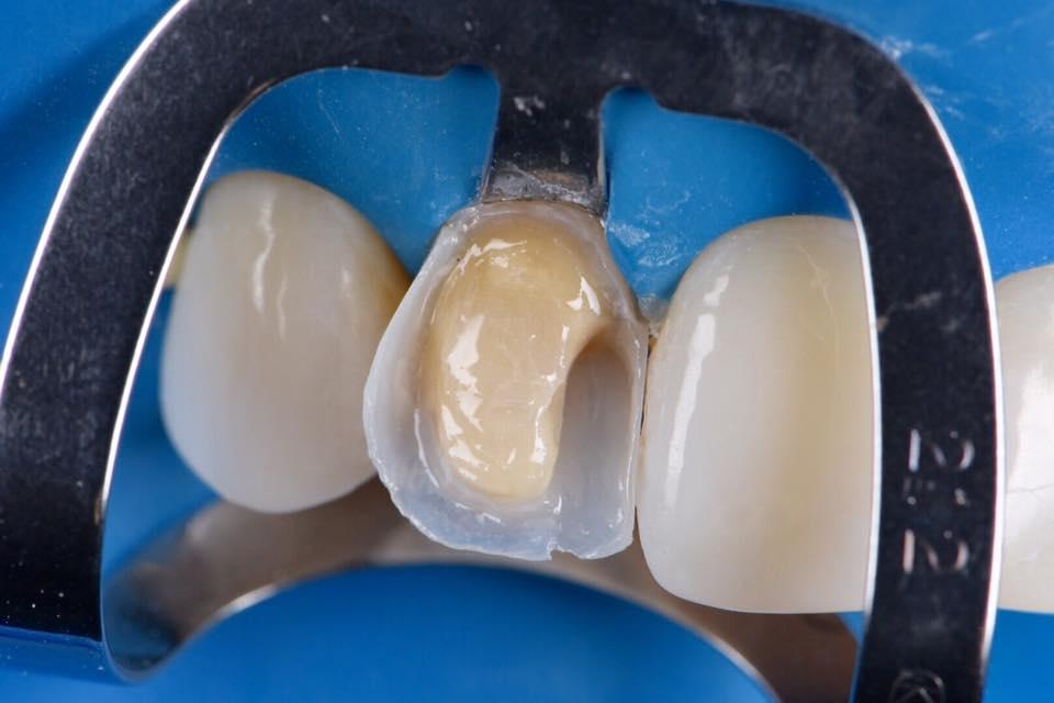 Зубная реставрация. Композитные виниры кариес. Композиты для передних зубов. Пломбирование фронтальных зубов.
