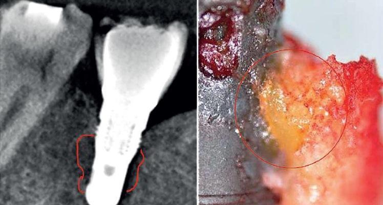 Почему титановые имплантаты провоцируют хроническое воспаление в костной ткани челюстей