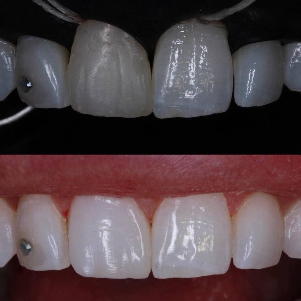 отбеливание при кариесе зубов