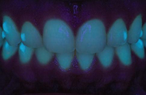 Ультрафиолет при лечении зубов