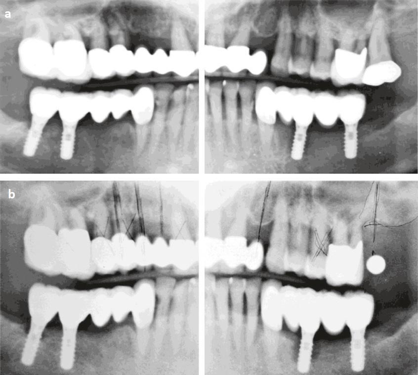 Восстановление костной ткани зубов. Атрофия костной ткани зуба. Атрофия костной ткани челюсти на снимке. Подсадка костной ткани в зуб.