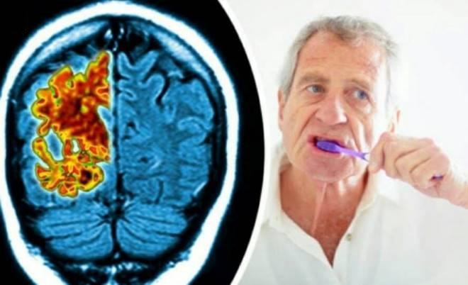 Взаимосвязь хронического пародонтита и болезни Альцгеймера