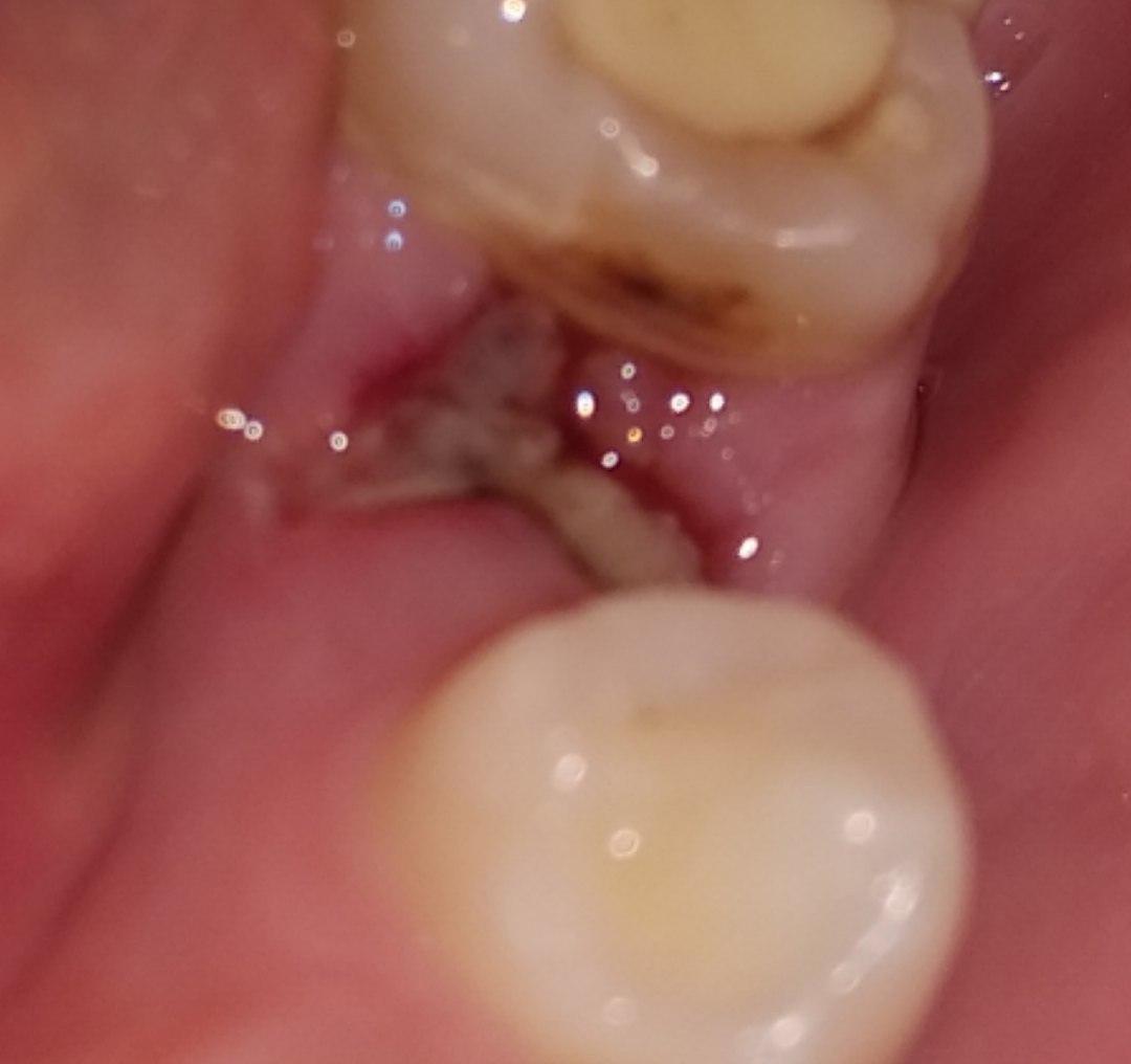 Белый налет на десне после удаления зуба