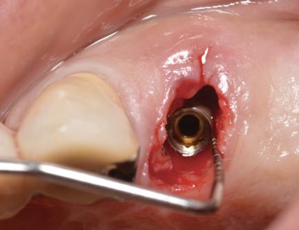 Субклассификация и клинический подход к лечению дентоальвеолярных дигесценций зубных лунок после экстракции