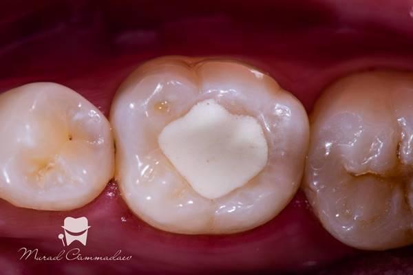 Метод ключа для реставрации жевательных зубов с несохраненной анатомией окклюзионной поверхности