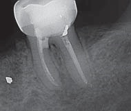 Инструмент при лечении зуба сломался