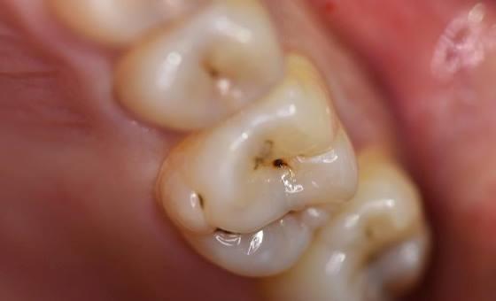 Лечение кариеса 25, 26 зубов с использованием материала Estelite Asteria
