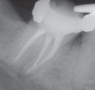 При лечении зуба остался инструмент