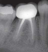 Перелом инструмента в канале зуба