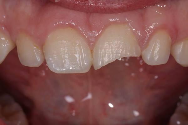 Лечение травмы зуба прямой реставрацией материалом Enamel hri