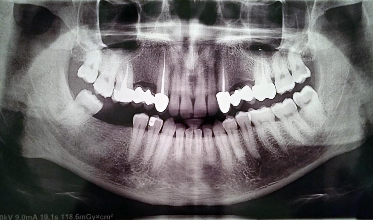 Панорамный снимок зубов Томск Географическая Лечение молочных зубов Томск Чекистский