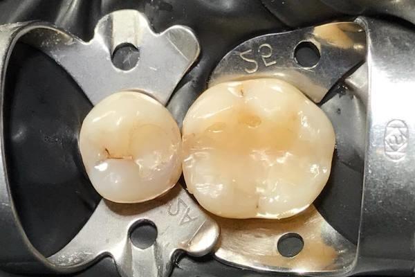 Замена пломб на зубах 3.6, 3.5 и восстановление контактного пункта между зубами