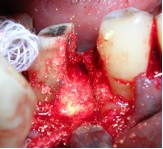Вертикальный перелом корня зуба thumbnail