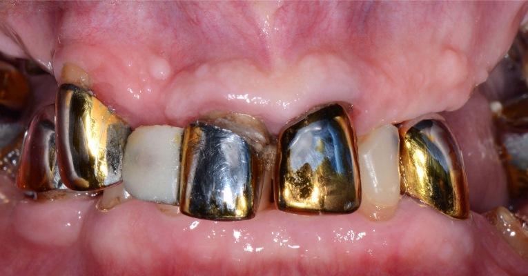 Тотальная реабилитация на зубах и имплантатах