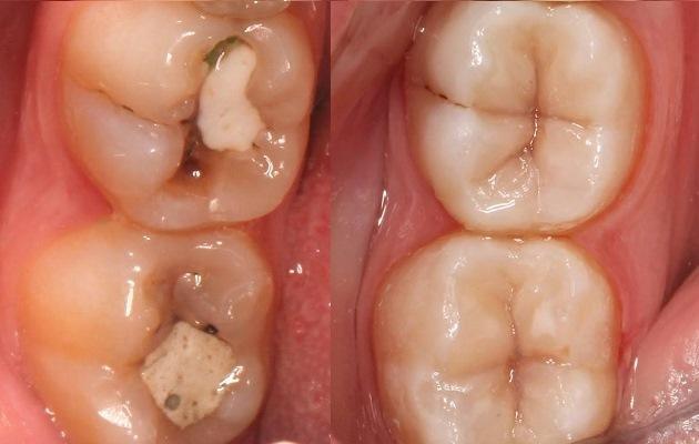 Эстетическая реставрация жевательных зубов