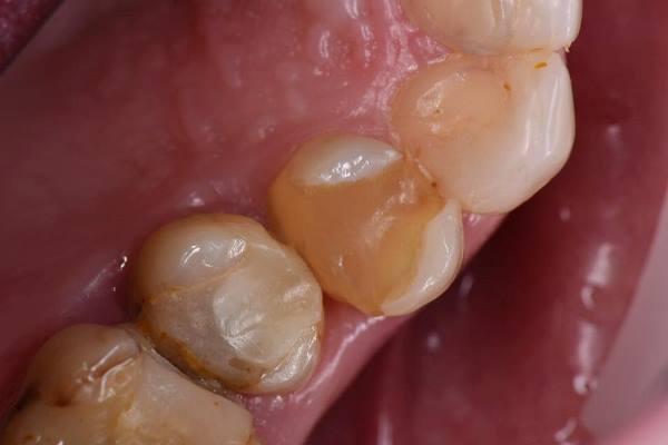 Прямая композитная реставрация зуба 1.4 после эндодонтического лечения  с помощью СВШ