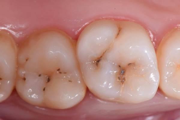 Лечение кариеса 1.6 и 1.7 зубов