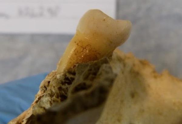 Эволюция микробов полости рта выявлена на зубах 4000-летней давности