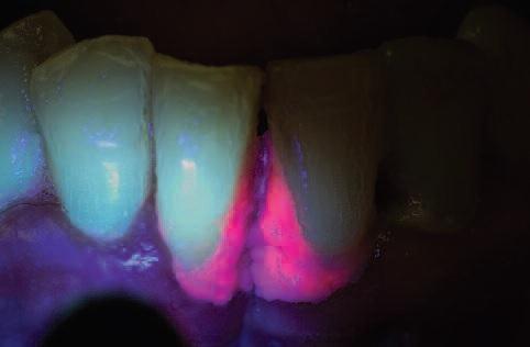 Лампа при лечении зубов