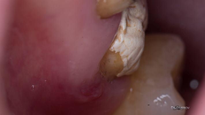 Поспешные выводы и неполная диагностика могут стоить пациенту зуба