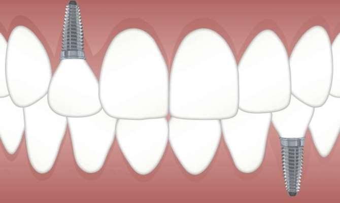 Применение электрохимической терапии для более эффективного лечения инфекции после фиксации зубных имплантатов