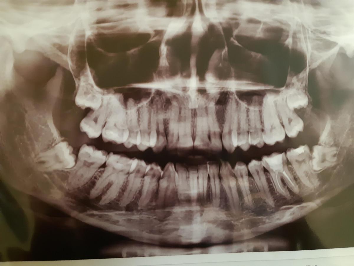 Болит челюсть после удаления зуба: причины, симптомы, что делать