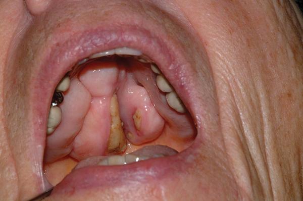 Планирование лечения эндодонтически пораженных зубов