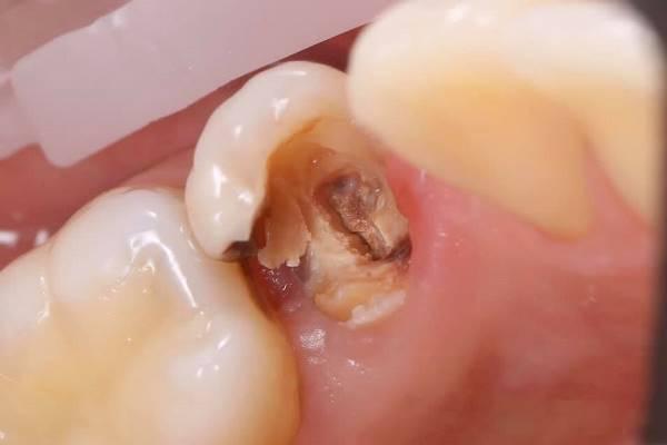 Восстановление стенок зуба перед эндодонтическим лечением