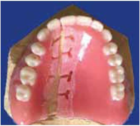 Починка, коррекция, перебазировка съемного протеза полного зубного ряда