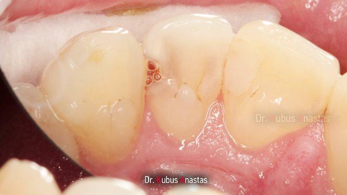 Проблемы и их решения при реставрации передних зубов
