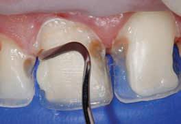 Метод лечение фронтальных зубов