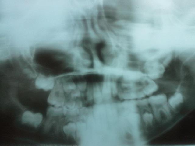 Фрейзера синдром изнутри рта фото