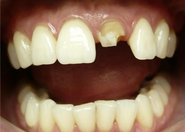 Метод инверсионного протезирования: восстановление культи зуба и фиксация безметалловой коронки