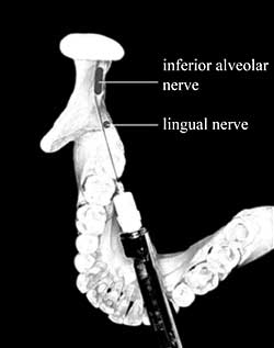 Путь введения иглы при проведении стандартной анестезии нижнего альвеолярного нерва.
