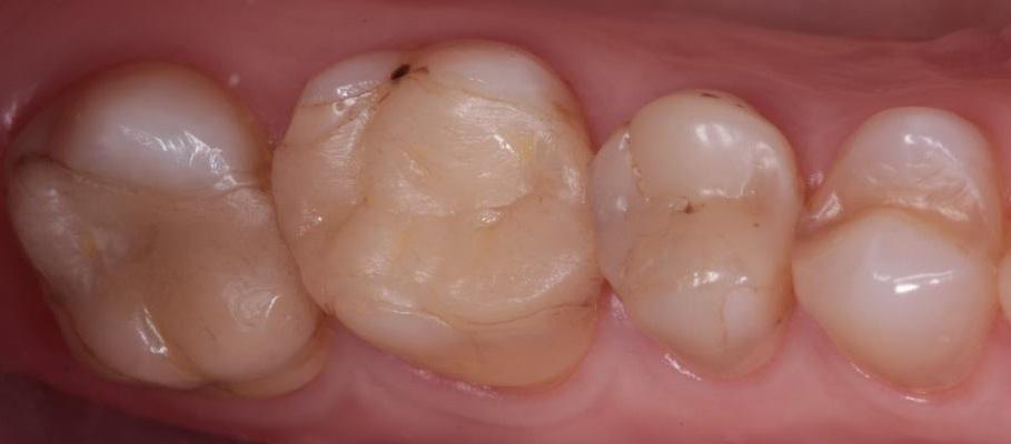 Прямая композитная реставрация перед ортодонтическим лечением
