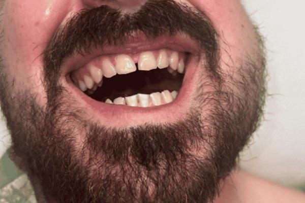 После удаления зуба мудрости у мужчины развивается редкий абсцесс в жевательной мышце