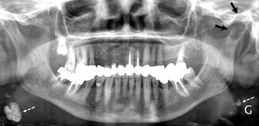 На обзорной рентгенограмме видна овальная тень с относительно чёткими контурами в головке мыщелка нижней челюсти слева (показана чёрными стрелками). Белыми пунктирными стрелками показаны кальцифицированные шейные лимфатические узлы.