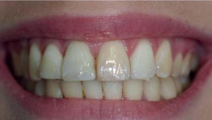 Эндодонтическое лечение кальцифицированного зуба