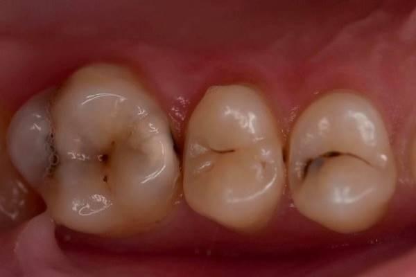 Реставрация зубов 1.6, 1.5, 1.4