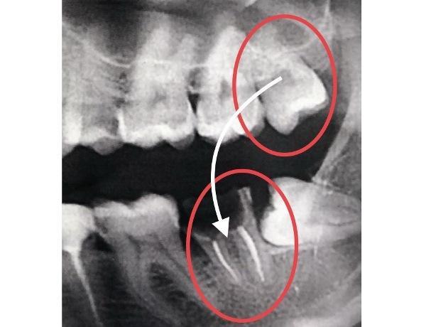 Трансплантация зуба 28 в лунку 37 зуба