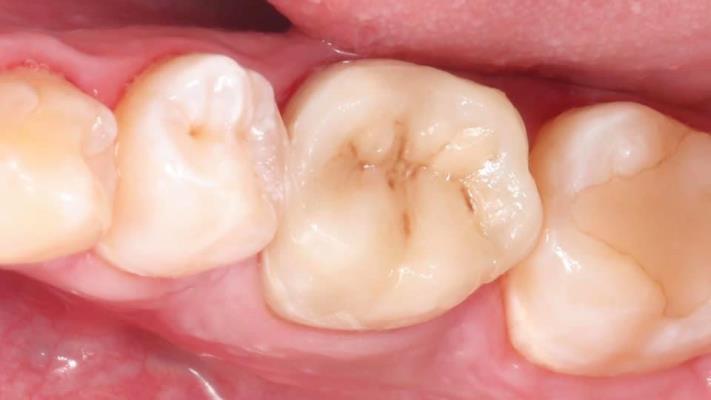 Сохранение зуба у молодого пациента