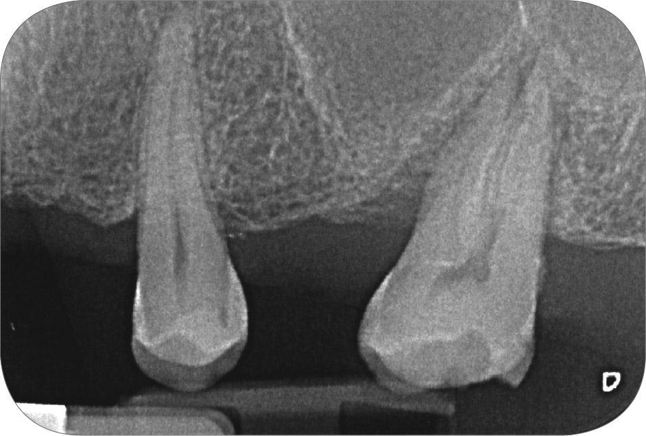 Подкожная эмфизема при лечении зуба thumbnail