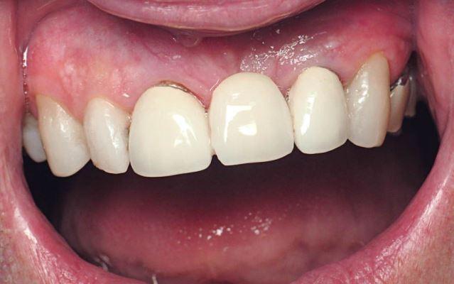 Конусные имплантаты Straumann Bone Level: обеспечение первичной стабильности и остеоинтеграции в зоне эстетических дефектов
